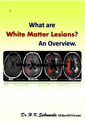 What are White Matter Lesions? An Overview.