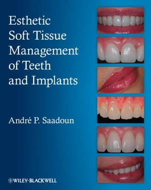 Esthetic Soft Tissue Management of Teeth and Implants