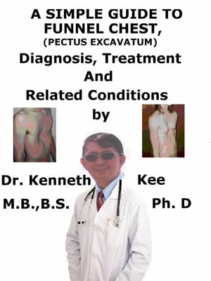 A Simple Guide to Funnel Chest (Pectus Excavatum