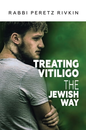 Treating Vitiligo The Jewish Way