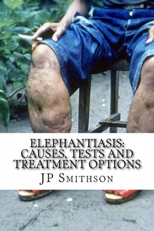 Elephantiasis: Causes, Tests and Treatment Optio