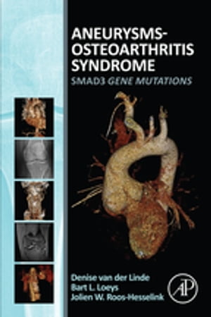 Aneurysms-Osteoarthritis Syndrome SMAD3 Gene Mutations【電子書籍】[ Jolien Roos-Hesselink ]