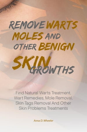 Remove Warts, Moles And Other Benign Skin Growths