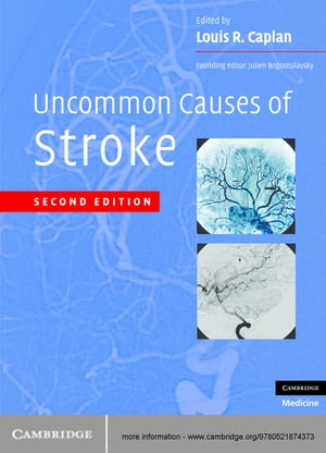 Uncommon Causes of Stroke