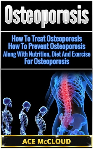 Osteoporosis: How To Treat Osteoporosis: How To Prevent Osteoporosis: Along With Nutrition, Diet And Exercise For Osteoporosis