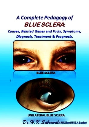 A Complete Pedagogy of BLUE SCLERA: Causes, Related Genes and Facts, Symptoms, Diagnosis, Treatment & Prognosis.