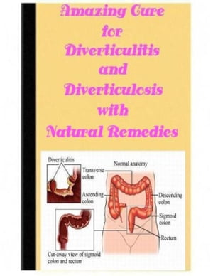 Amazing Cure for Diverticulitis and Diverticulosis with Natural Remedies