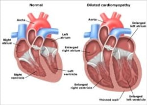 Dilated Cardiomyopathy: Causes, Symptoms and Treatments