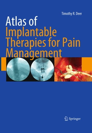 Atlas of Implantable Therapies for Pain Management