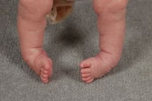 Clubfoot: Causes, Symptoms and Treatments