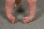 Clubfoot: Causes, Symptoms and Treatments