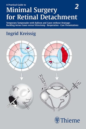 A Practical Guide to Minimal Surgery for Retinal Detachment, Vol. 2