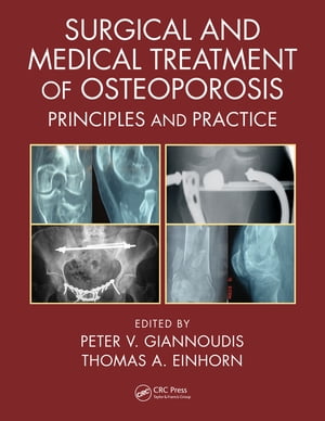 Surgical and Medical Treatment of Osteoporosis