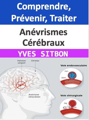 Anévrismes Cérébraux : Comprendre, Prévenir, Traiter