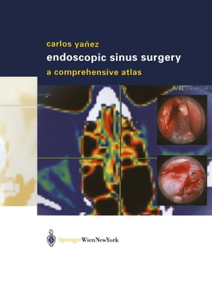 Endoscopic Sinus Surgery