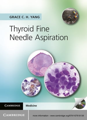 Thyroid Fine Needle Aspiration