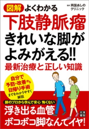 図解 よくわかる下肢静脈瘤 きれいな脚がよみがえる!! 最新治療と正しい知識