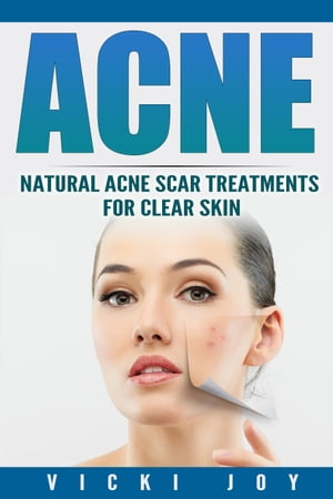 ACNE Natural Acne Scar Treatments for Clear Skin【電子書籍】 Vicki Joy