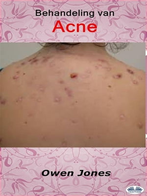 Behandeling Van Acne