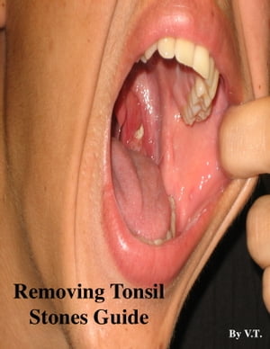 Removing Tonsil Stones Guide