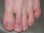 Chilblains: Causes, Symptoms and Treatments
