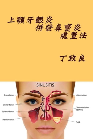 上顎牙齦炎併發鼻竇炎及竇口通處置法 Proposed Treatments for Odontogenic Maxillary Sinusitis and Oroantral Fistula