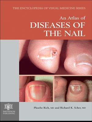 An Atlas of Diseases of the Nail