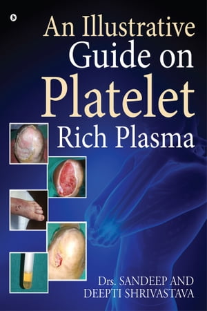 An Illustrative Guide on Platelet Rich Plasma【