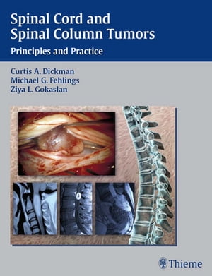 Spinal Cord and Spinal Column Tumors