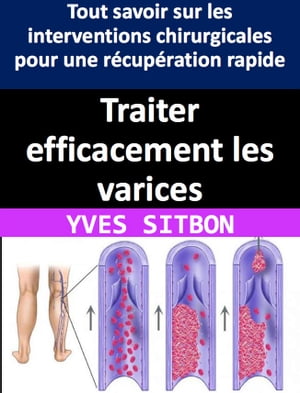 Traiter efficacement les varices : Tout savoir sur les interventions chirurgicales pour une récupération rapide