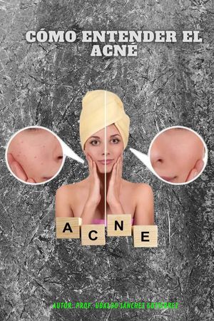 Entendiendo el acné