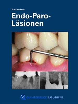 Endo-Paro-Läsionen