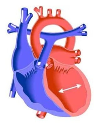 Cardiomyopathy: Causes, Symptoms and Treatments