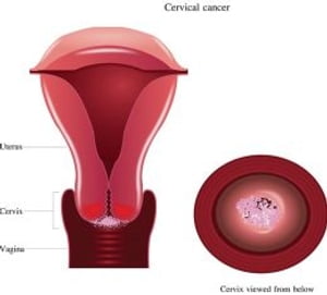 Cervical Cancer: Causes, Symptoms and Treatments