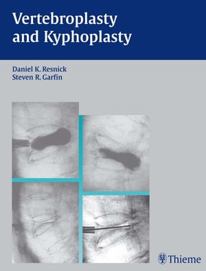 Vertebroplasty and Kyphoplasty