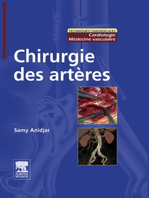 Chirurgie des artères