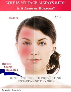 Why is my face always red? Is it Acne or Rosacea?: 3 step process to preventing Rosacea and Dry Skin