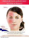 Why is my face always red Is it Acne or Rosacea : 3 step process to preventing Rosacea and Dry Skin【電子書籍】 Vadim Kravetsky