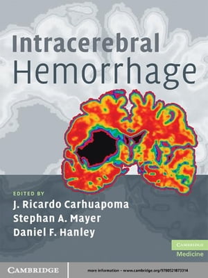 Intracerebral Hemorrhage