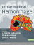 Intracerebral Hemorrhage