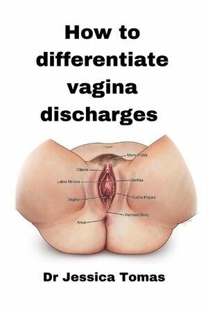 Howw To Differentiate Vagina Discharges