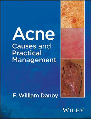 Acne Causes and Practical Management【電子書籍】[ F. William Danby ]