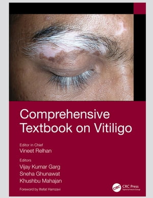 Comprehensive Textbook on Vitiligo