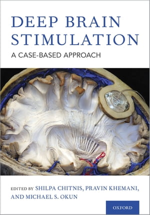 Deep Brain Stimulation A Case-based Approach【電子書籍】