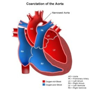 Coarctation of the Aorta: Causes, Symptoms and Treatments