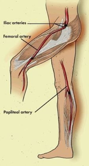 Claudication: Causes, Symptoms and Treatments