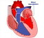 Cardiogenic Shock: Causes, Symptoms and Treatments