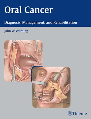 Oral Cancer Diagnosis, Management, and Rehabilitation【電子書籍】