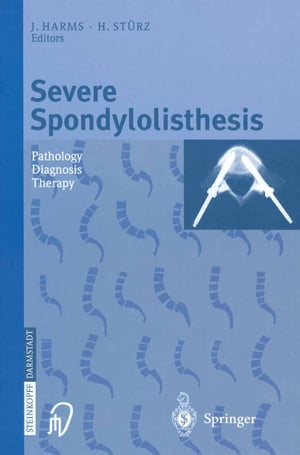 Severe Spondylolisthesis Pathology - Diagnosis - Therapy【電子書籍】