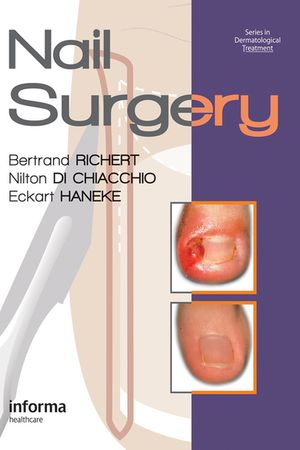 Nail Surgery【電子書籍】[ Bertrand Richert ]